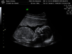 Ultrasound Sonogram Jonah